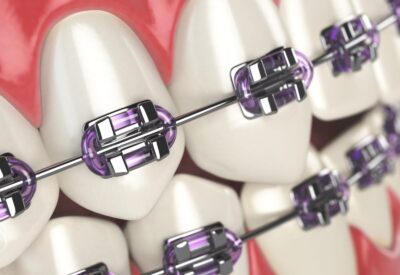 Purple braces on teeth